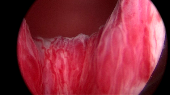 图：膀胱镜下怒张的前列腺表面血管。