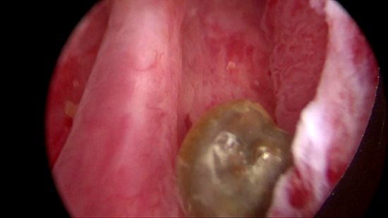 图：膀胱镜下位于前列腺部尿道腔内的小结石。