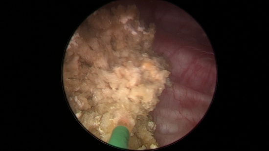 图：膀胱镜下膀胱结石拟内镜下激光碎石。